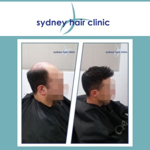 Sydney hair clinic, men's toupees, hair systems, hair pieces, wigs