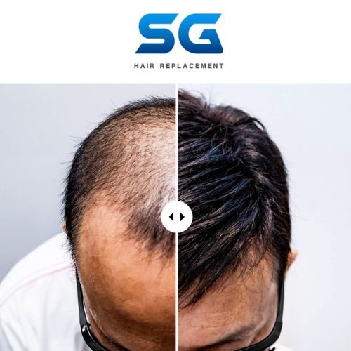 Bespoke wigs SG hair replacement Singapore