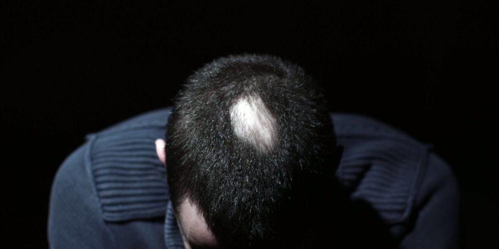 Man with Alopecia areata, bald patch